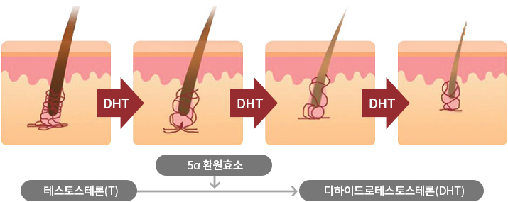 테스토스테론(T) → 5α 환원효소  → 디하이드로테스토스테론(DHT)